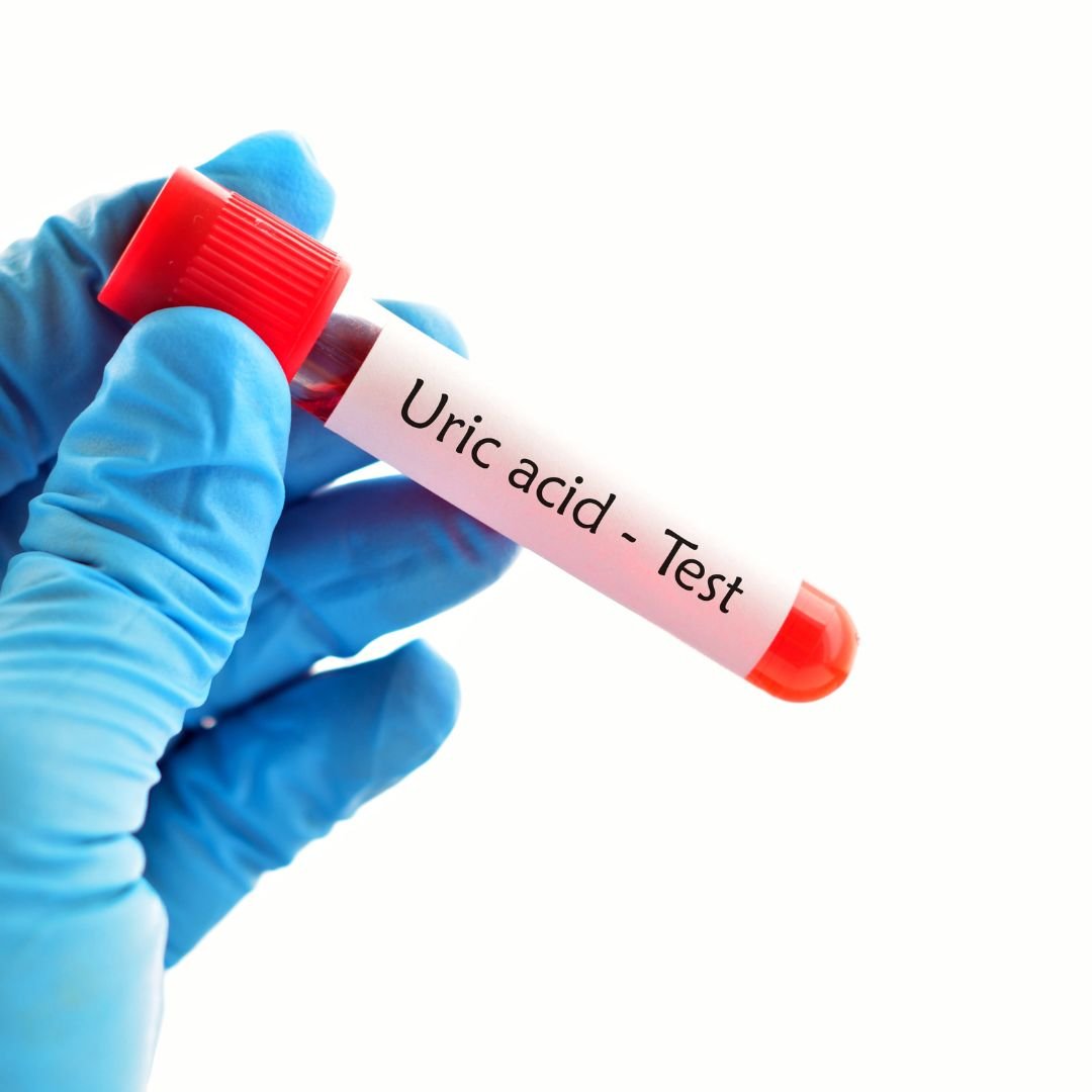 High Uric Acid Diet